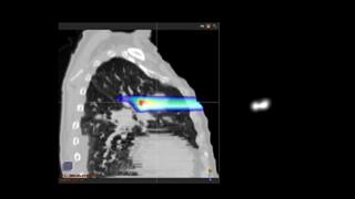 Advantages of Proton Therapy - Willis Knighton Cancer Center