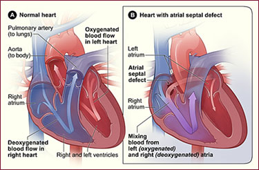 PFO/ASD Closure - Interventional Cardiology - Willis-Knighton Heart ...