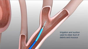 SpyGlass DS Direct Visualization System - Innovative Technology ...