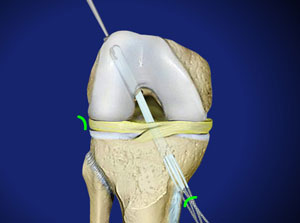 ACL Reconstruction with Hamstring Using ARTHROTEK® and EZLoc Devices ...