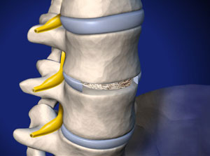 ALIF: Anterior Lumbar Interbody Fusion (with bone graft and metal plate)