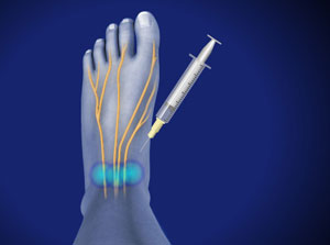 Ankle Nerve Block