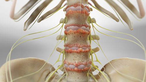 Ankylosing Spondylitis (AS)