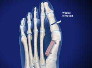 Bunion Correction With Scarf And Akin Osteotomy