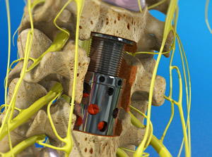 Anterior Cervical Corpectomy