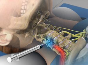 Cervical Transforaminal Epidural Steroid Injection