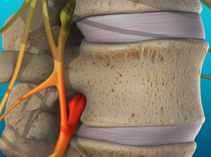 Vertebral Subluxation