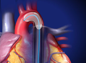 Aortic Coarctation Balloon Angioplasty