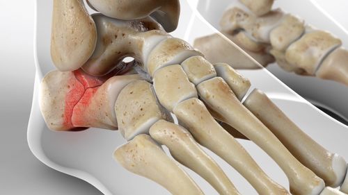 Calcaneus Fracture (Heel Bone Fracture) - Willis-Knighton Health System