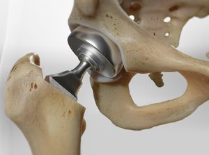 Hemiarthroplasty (Unipolar Prosthesis)