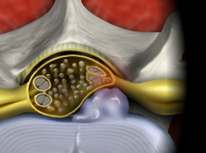 Intralaminar Lumbar Microendoscopic Discectomy