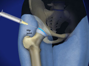 injection in hip
