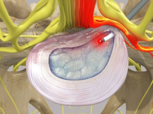 Percutaneous Laser Disc Decompression (PLDD)