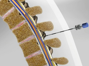 Diagnostic Lumbar Puncture (Spinal Tap) - Willis-Knighton Health System ...