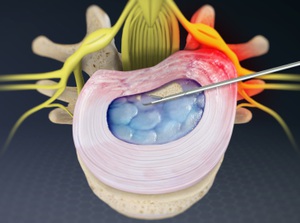 Microdiscectomy with Annuloplasty (Lumbar Spine, Percutaneous Approach)