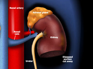 da Vinci® Partial Nephrectomy