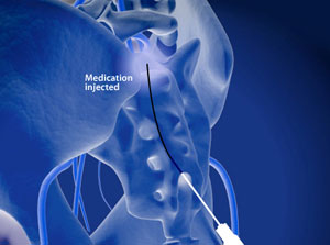 RACZ Caudal Neurolysis - Willis-Knighton Health System