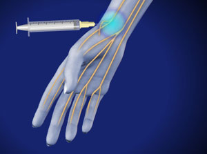 Radial Nerve Block