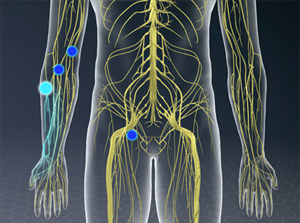 Sciatic Nerve Block (Posterior Approach, Electric Stimulation) -  Willis-Knighton Health System