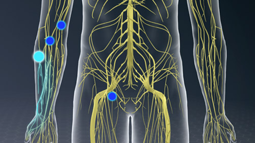 Regional Anesthesia