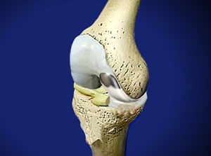 Unicondylar Knee Resurfacing