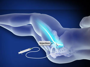 Sciatic Nerve Block Posterior Approach Ultrasound Guided