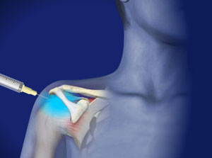 Soft Tissue Injection: Shoulder - Willis-Knighton Health System