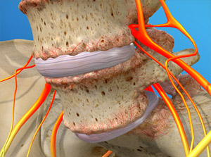 Spondylolisthesis