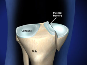tibial condyle fracture