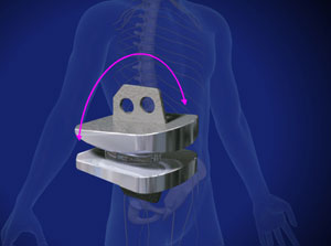 Disc Replacement, Lumbar (Maverick) - Willis-Knighton Health System