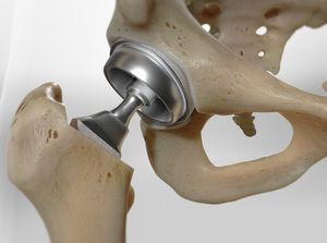 Total Hip Replacement (Minimally-Invasive Method, Large-Diameter Bearing)