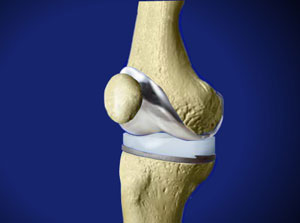 Total Knee Replacement (Wright) - Willis-Knighton Health System ...