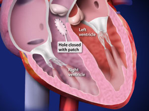 Ventricular Septal Defect (VSD) - Willis-Knighton Health System