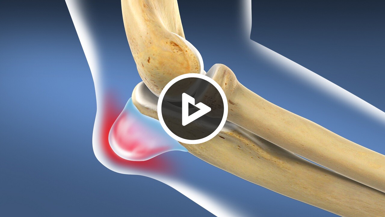 Elbow Bursitis - Disease & Condition Information - Willis Knighton Health - Top Hospitals and Doctors in Shreveport