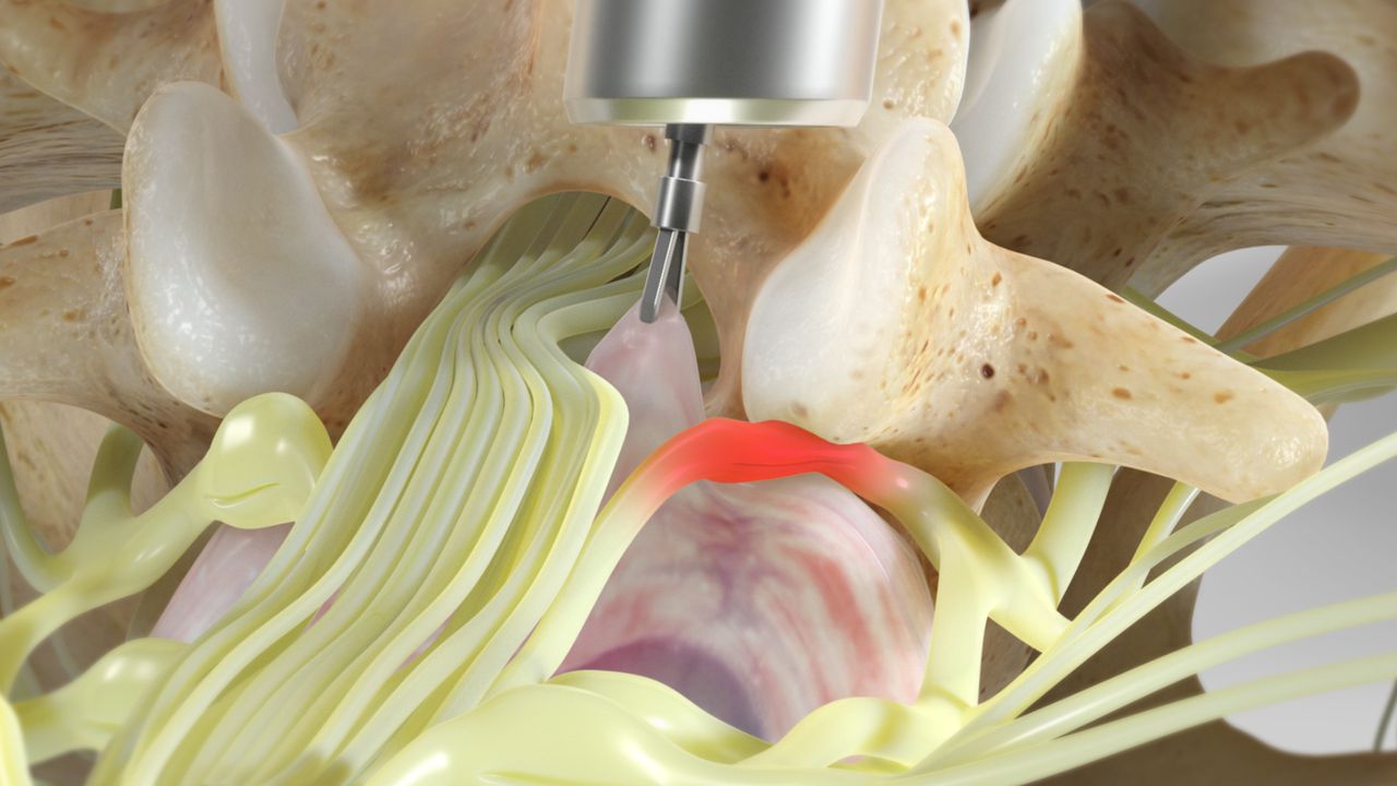 Micro Endoscopic Discectomy (in the Lumbar Spine)