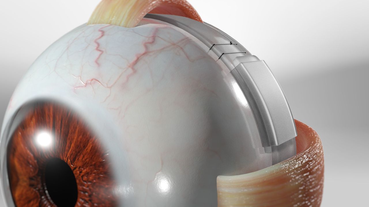 Scleral Buckling