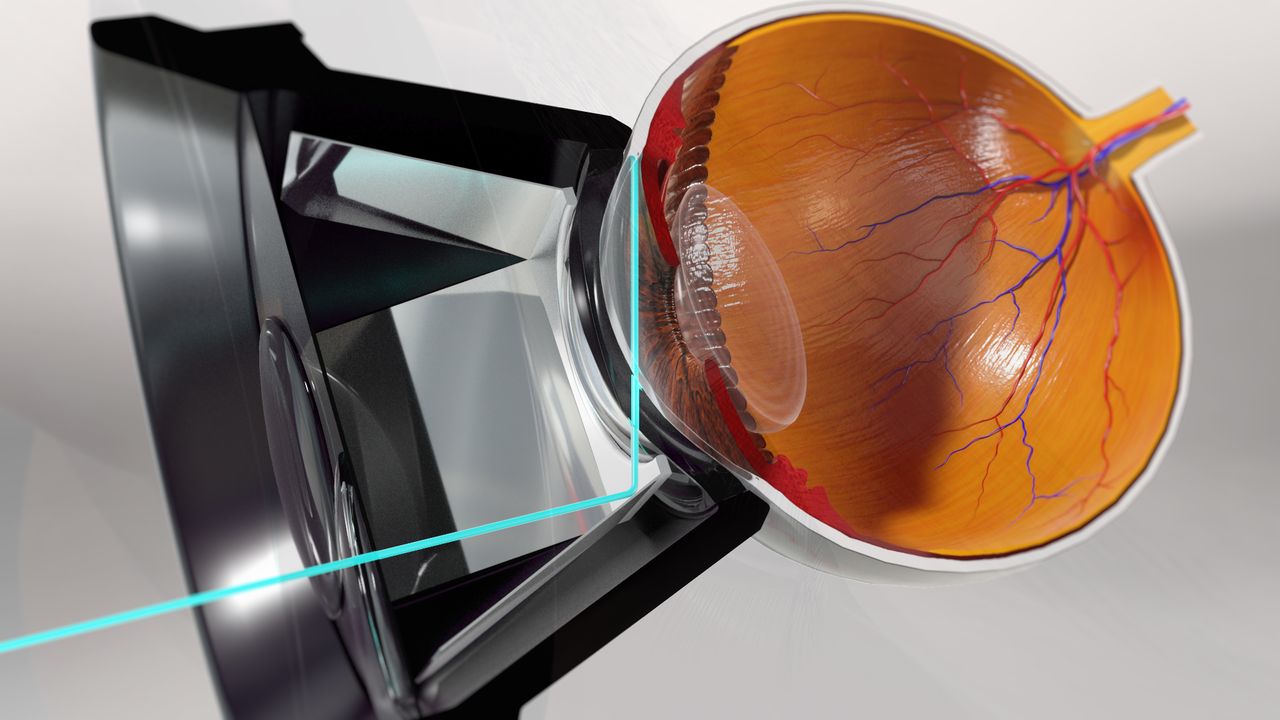 Selective Laser Trabeculoplasty (SLT)