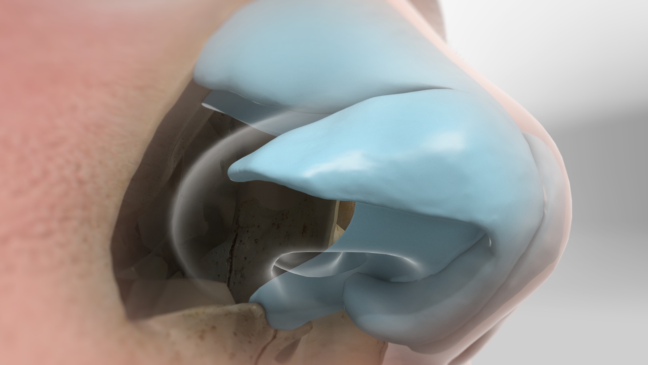 septoplasty