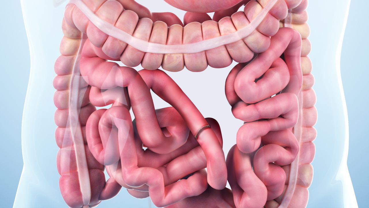 smallbowelresect_1280