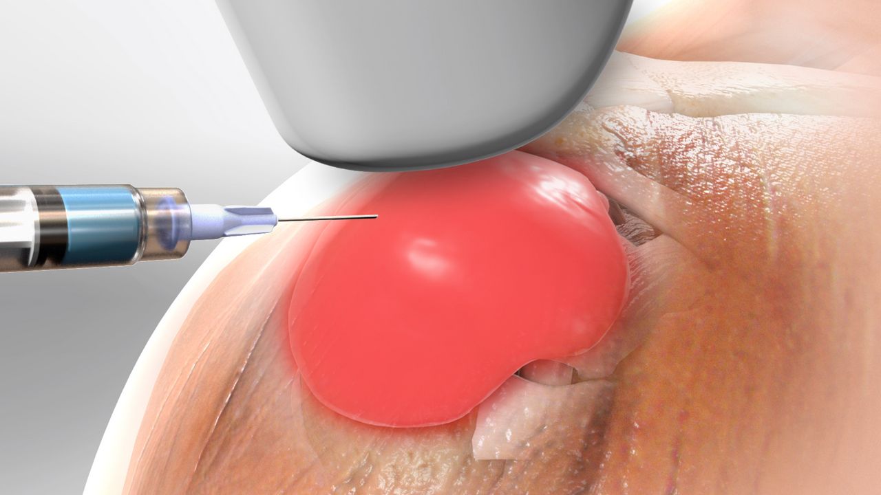 softtissinjectshoulder_1280