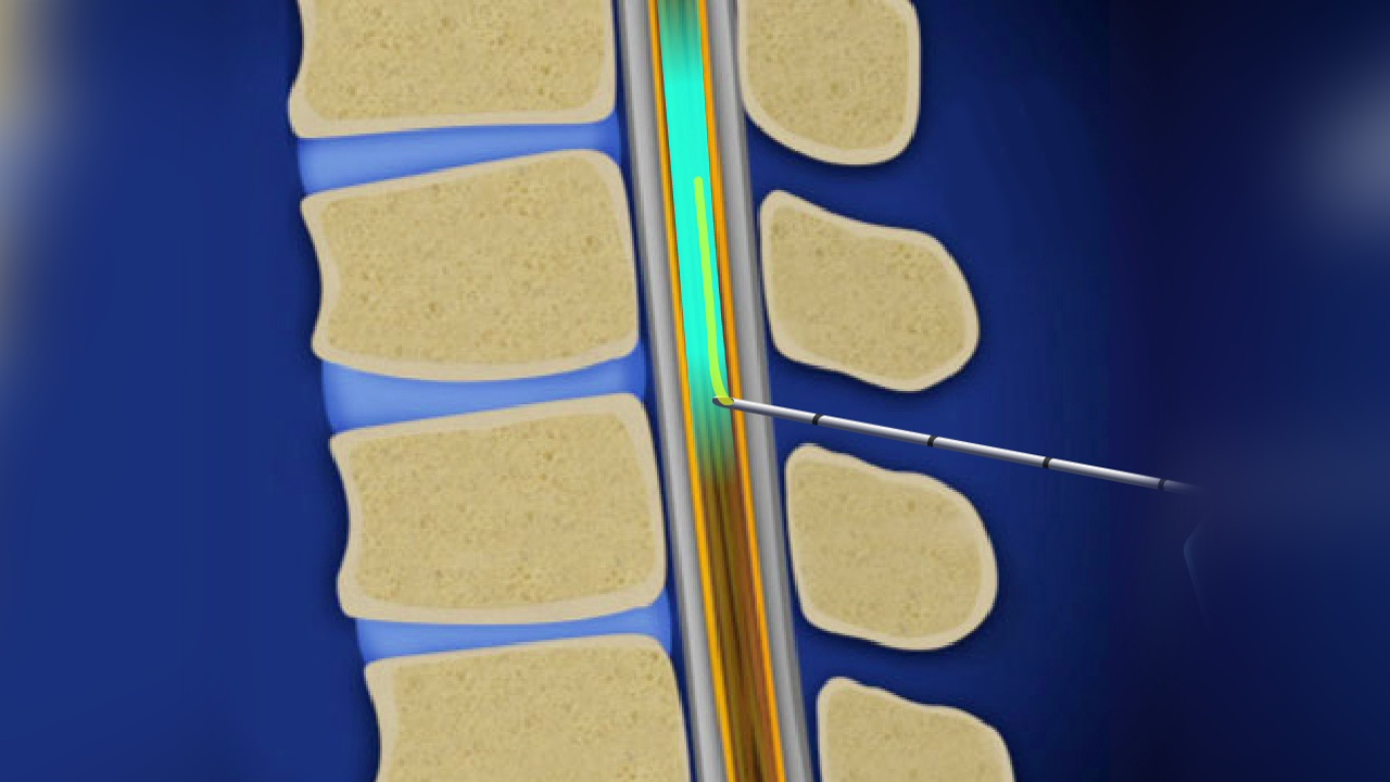 spinalanesthesiaforhip_1280