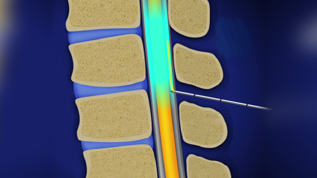 spinalepiduralforhip_1280