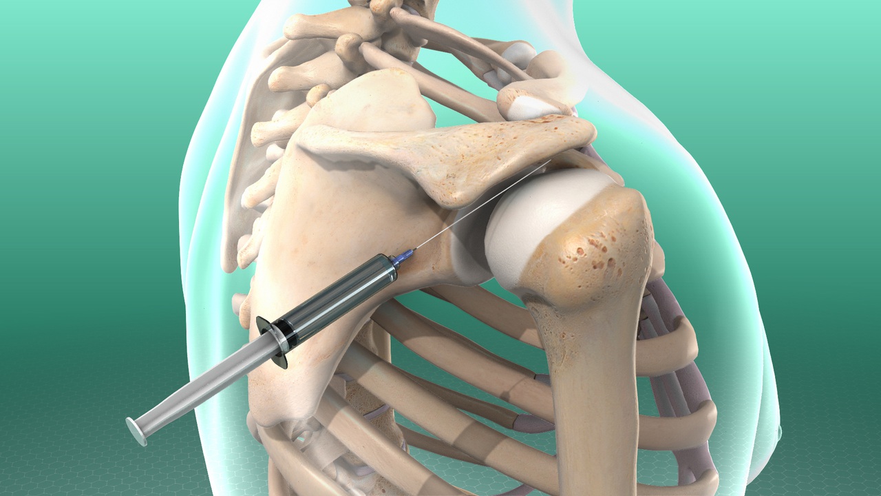 subacromialinject_1280