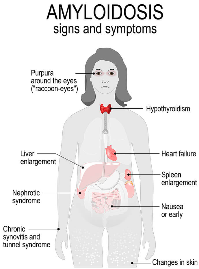 Amyloidosis
