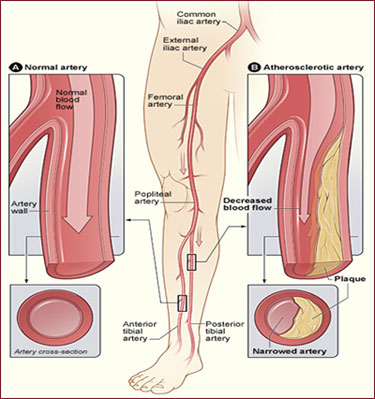 Peripheral Laser Atherectomy